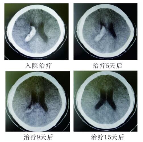腦出血你不得不引起重視的疾?。。。?></a></div>
               
 					<div   id=