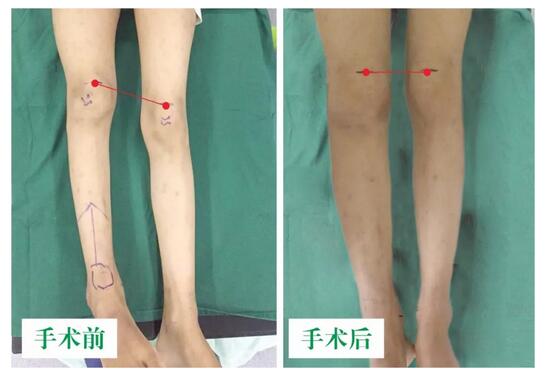 女孩墜梯右腿縮短5cm，幸得醫(yī)生及時診治恢復(fù)正常腿型