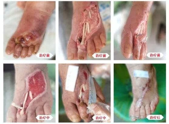 糖尿病并發(fā)癥有多可怕，及時治療糖尿病足避免截肢！
