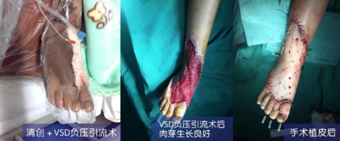 車禍猛如虎，救治如“華佗” ，手術(shù)＋康復(fù)，8歲小女孩車禍后日漸康復(fù)行走