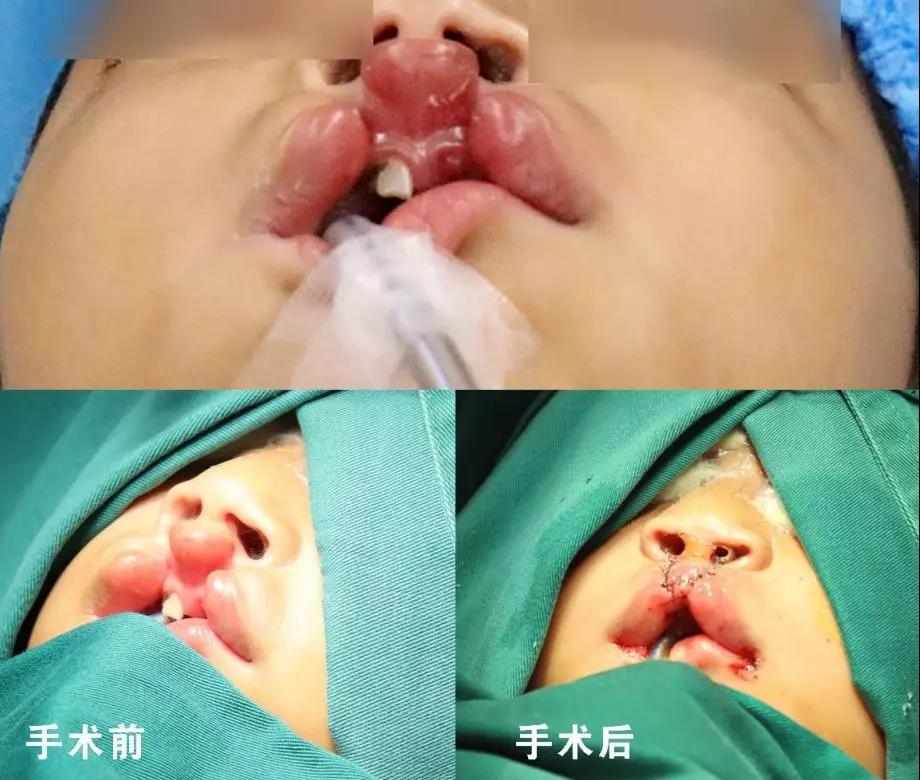 唇腭裂盡早治療消除孩子自卑心理，快樂成長！