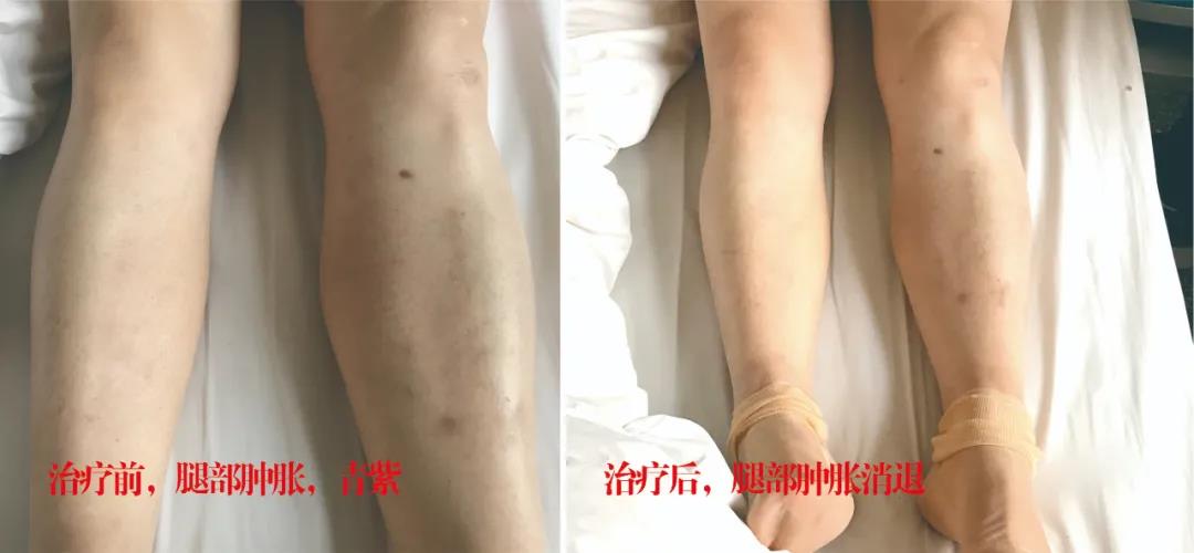 下肢靜脈血栓多年頑疾反復(fù)腫痛——疾病不容等待，早治療，早健康！