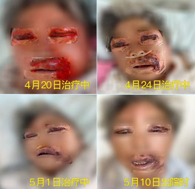 膿毒血癥（急性頜面部蜂窩組織炎）多學(xué)科聯(lián)合會(huì)診，幫助患者成功治愈！
