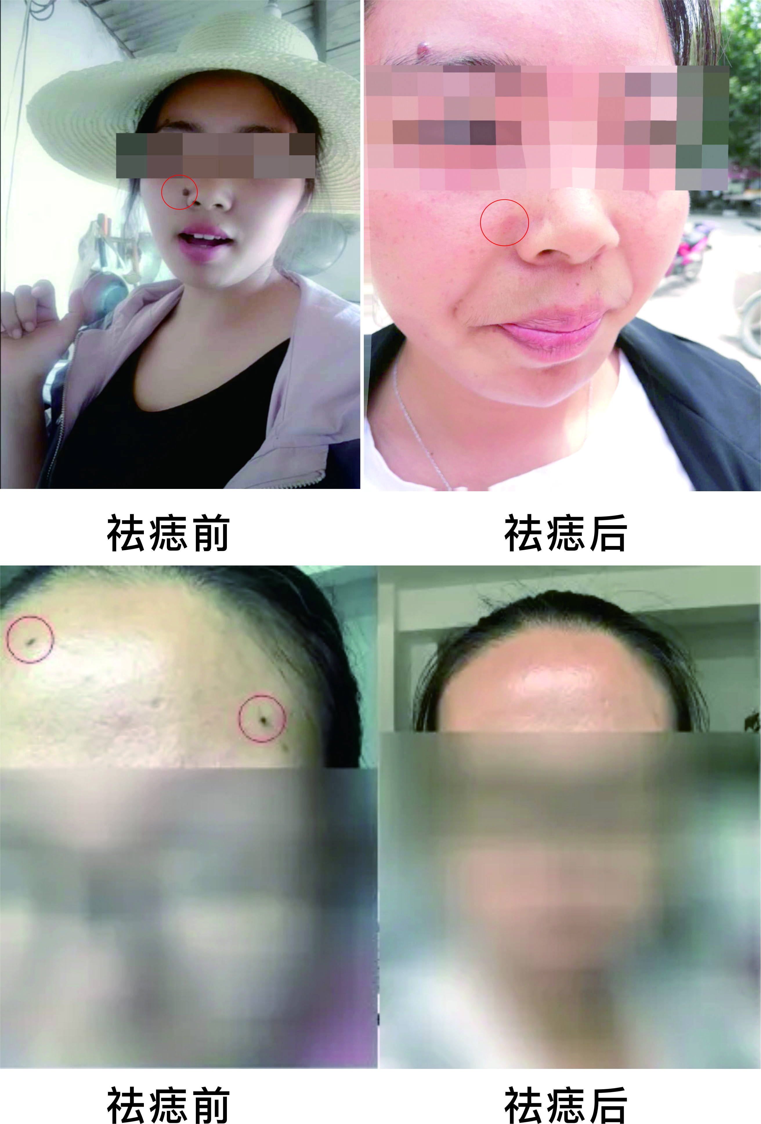 微波祛痣，告別臉部多余的“點(diǎn)綴”~