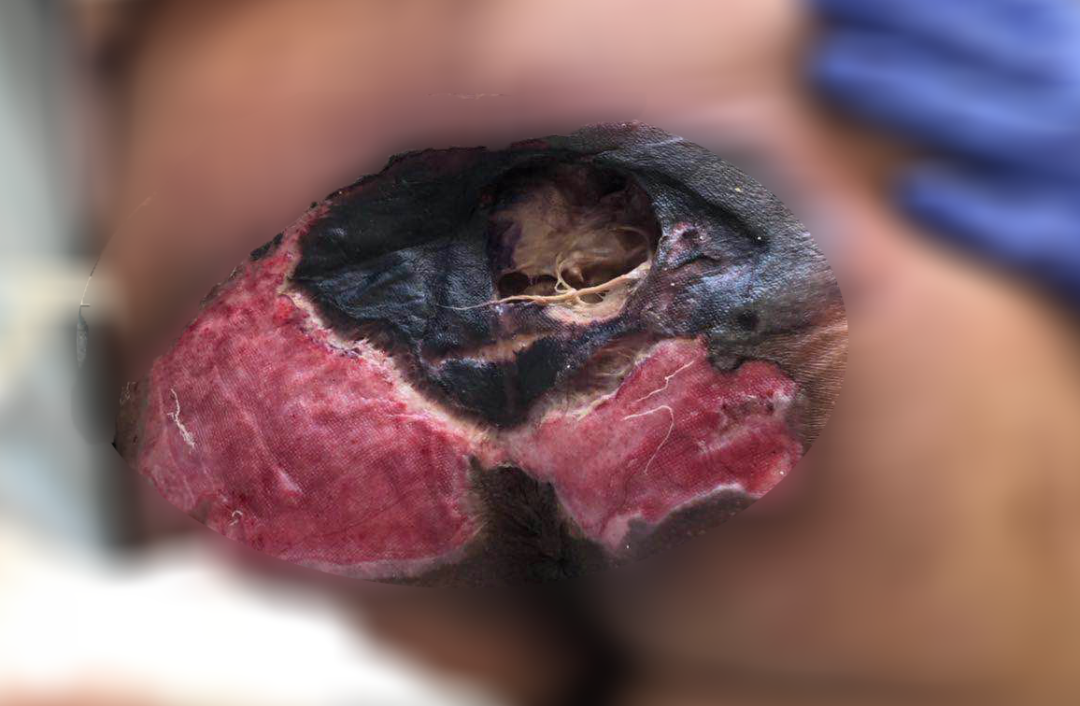 癱瘓3年的女患者臀部居然變成這樣?！