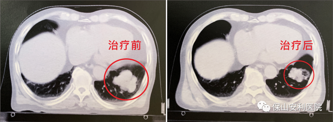 不做手術，早期肺癌也能根治！