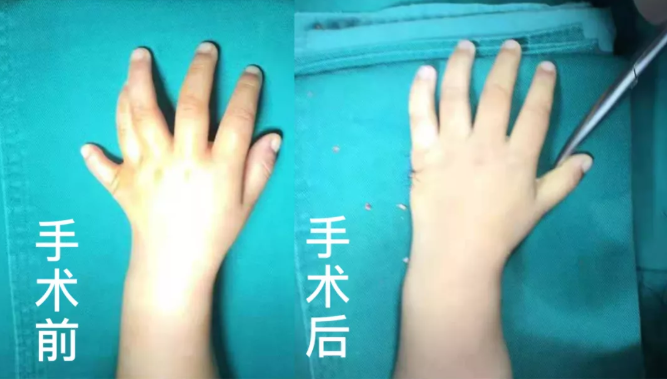 【保山安利醫(yī)院】2歲小兒手、足多指（趾）成功修復(矯正）！
