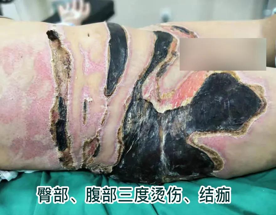 【保山安利醫(yī)院】80歲老人不慎燒傷，導(dǎo)致腹部、右側(cè)臀部大面積創(chuàng)傷，經(jīng)植皮治療創(chuàng)面逐漸愈合