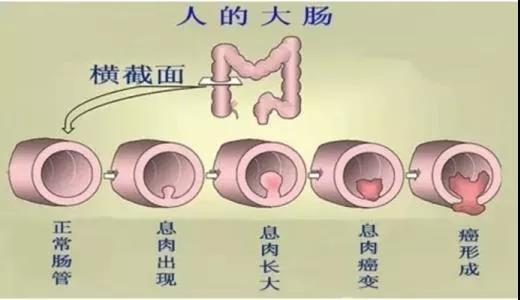 體檢發(fā)現(xiàn)腸息肉會癌變嗎？