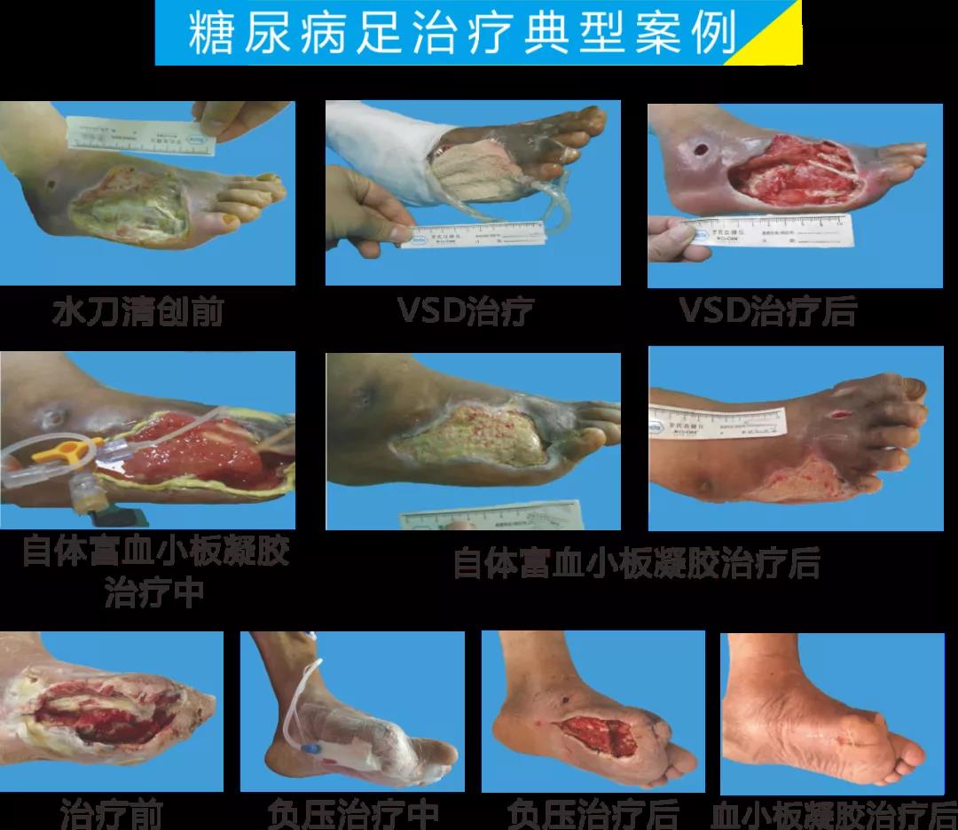 截肢、失明，甚至……，我們要做的是將糖尿病并發(fā)癥遏制在搖籃里！
