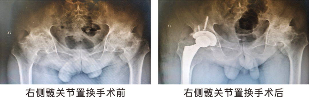 【保山安利醫(yī)院】長期飲酒導致雙側(cè)股骨頭壞死，髖關節(jié)置換后重獲運動功能！