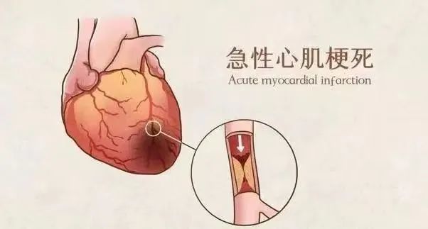 【保山安利醫(yī)院】11月20日“心梗救治日” 時間就是心肌，時間就是生命！